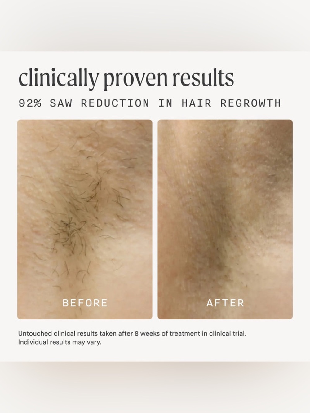NOOD Black Handheld Hair Removal Device - Multi-Area Use - Picture 2 of 5